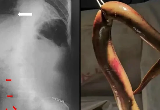 Rare Medical Case: Live Catfish Removed From a Bangladeshi Fisherman's Colon