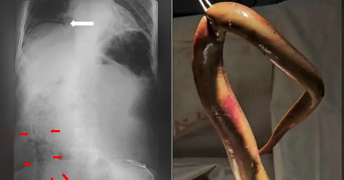 Rare Medical Case: Live Catfish Removed From a Bangladeshi Fisherman's Colon
